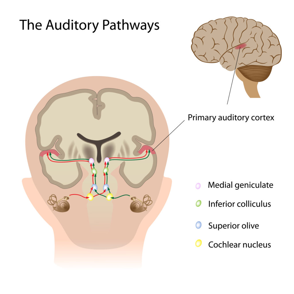 types of auditory processing disorder