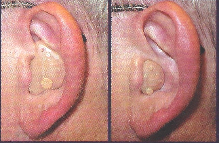 full-shell-half-shell-ITE-hearing-aid